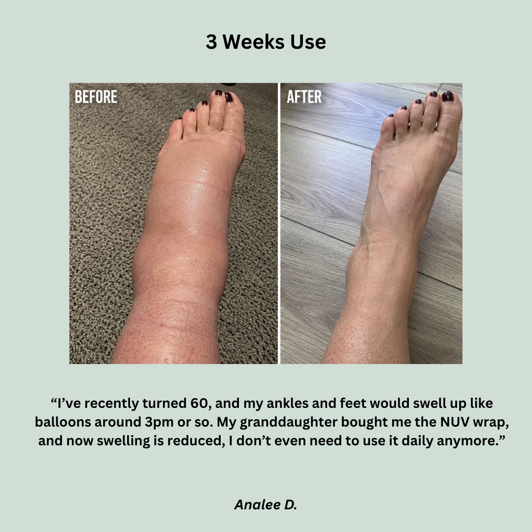 NUV Ankle Edema Wrap - Say Goodbye To Swollen Ankles